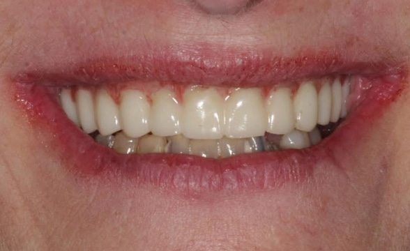 Blog - Precision Dentistry of Howard