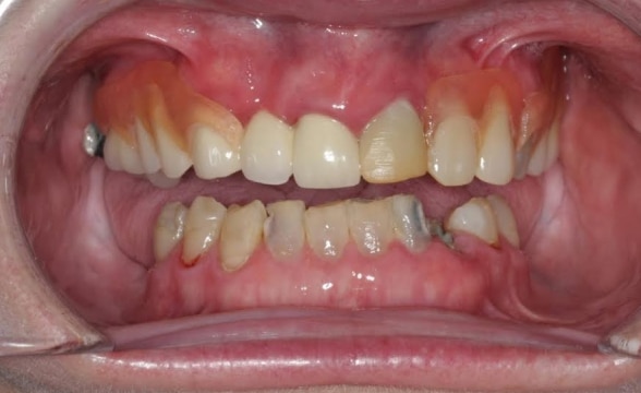 Blog - Precision Dentistry of Howard