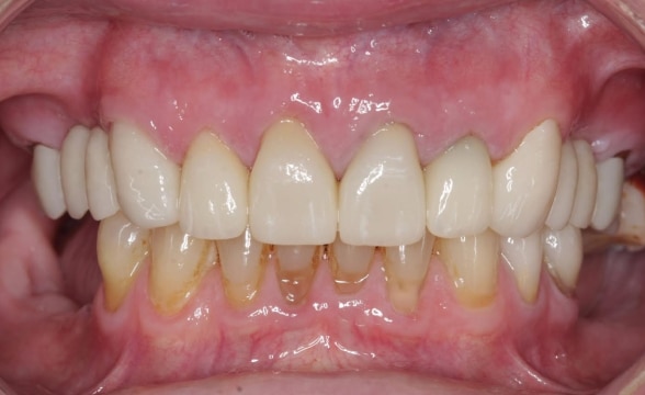 Restorative Dentistry - Precision Dentistry of Howard