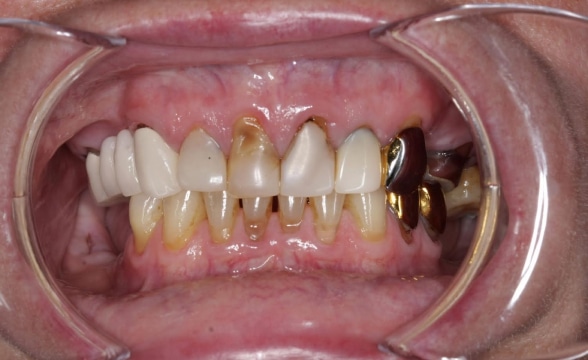 Overdentures - Precision Dentistry of Howard