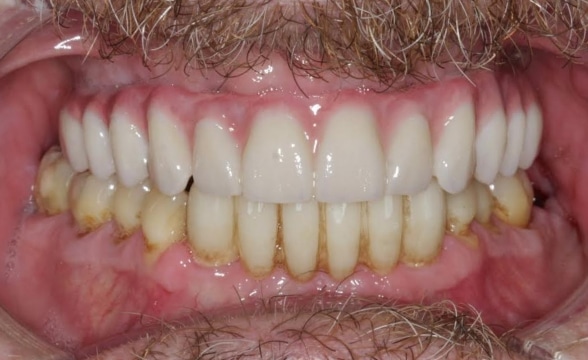 Blog - Precision Dentistry of Howard