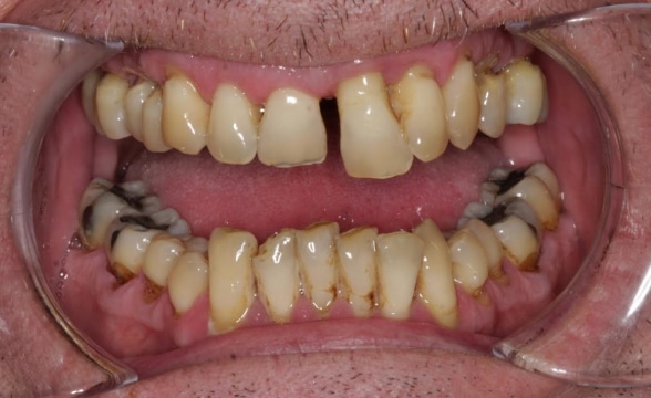 Dentures - Precision Dentistry of Howard