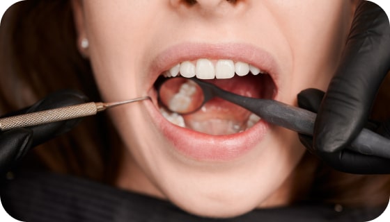 Gum Disease Treatment - Precision Dentistry of Howard
