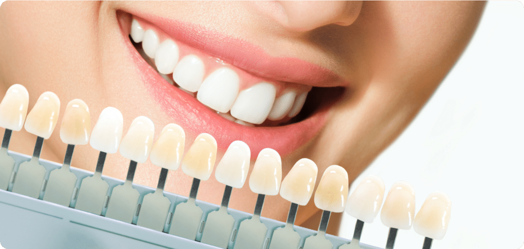 Veneers - Precision Dentistry of Howard