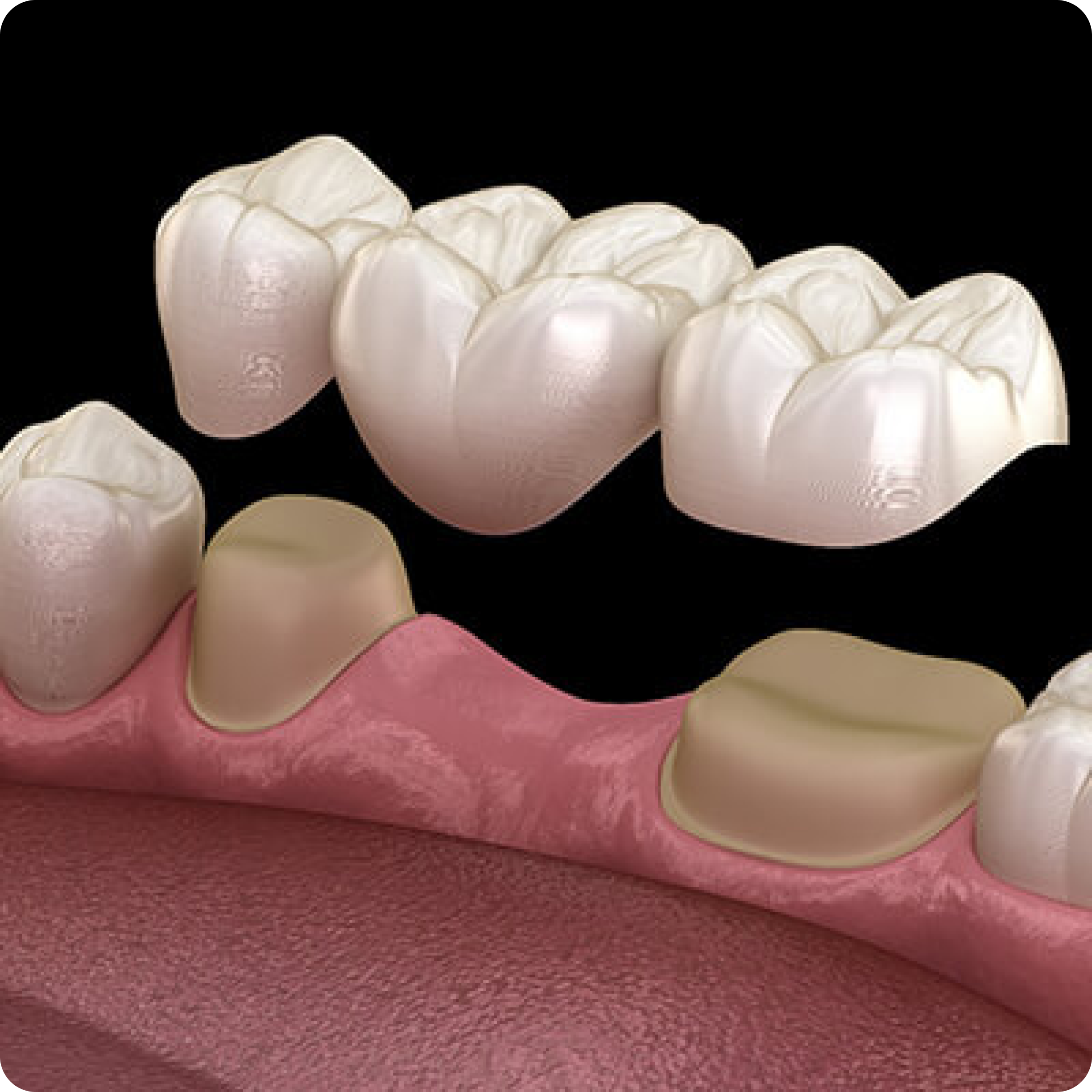 Dental Bridge - Precision Dentistry of Howard