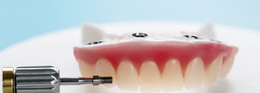 Overdentures - Precision Dentistry of Howard