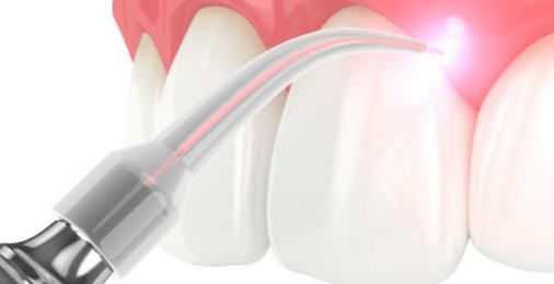 Laser Dental Procedures - Precision Dentistry of Howard