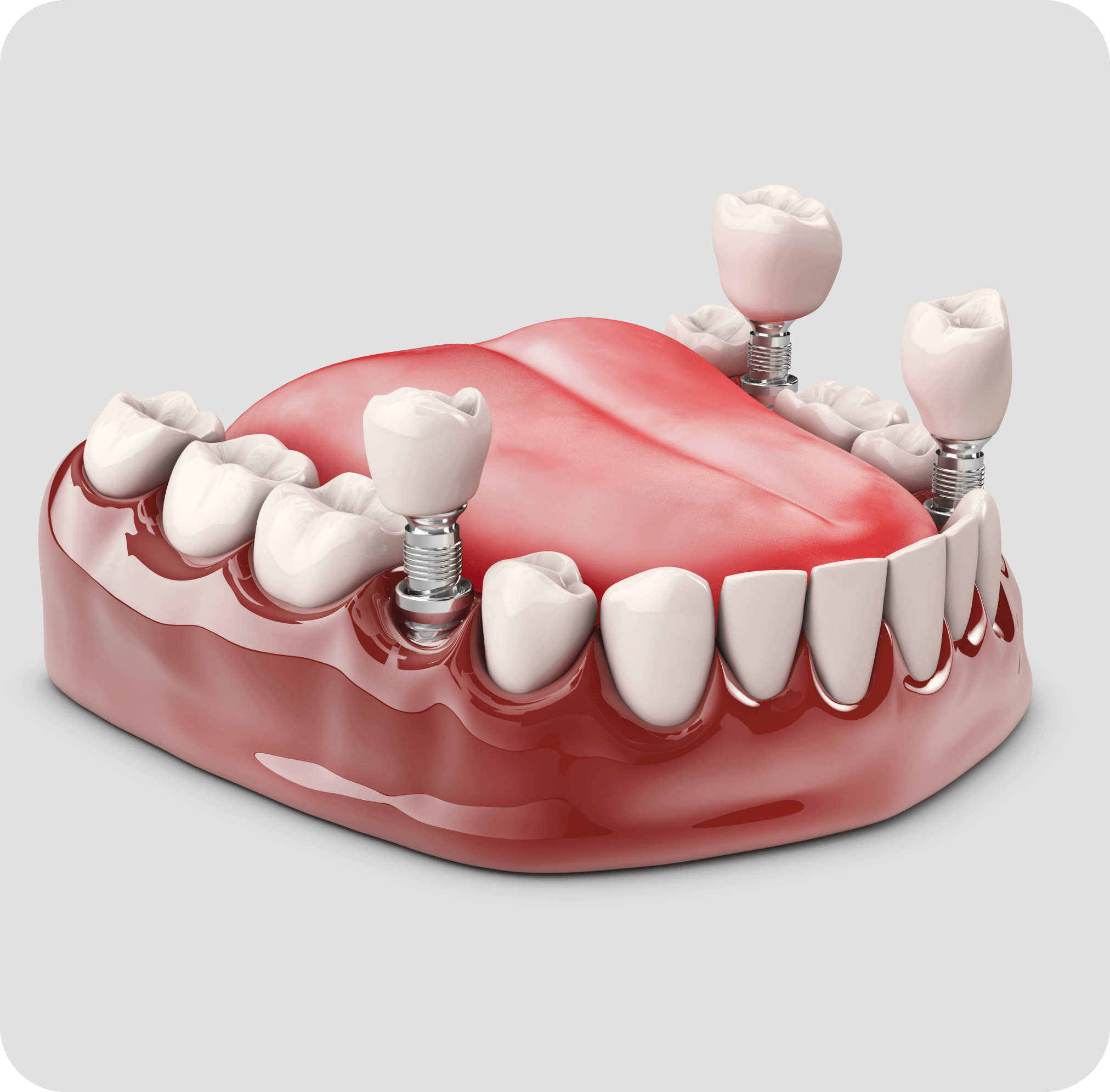 Dental Implants - Precision Dentistry of Howard