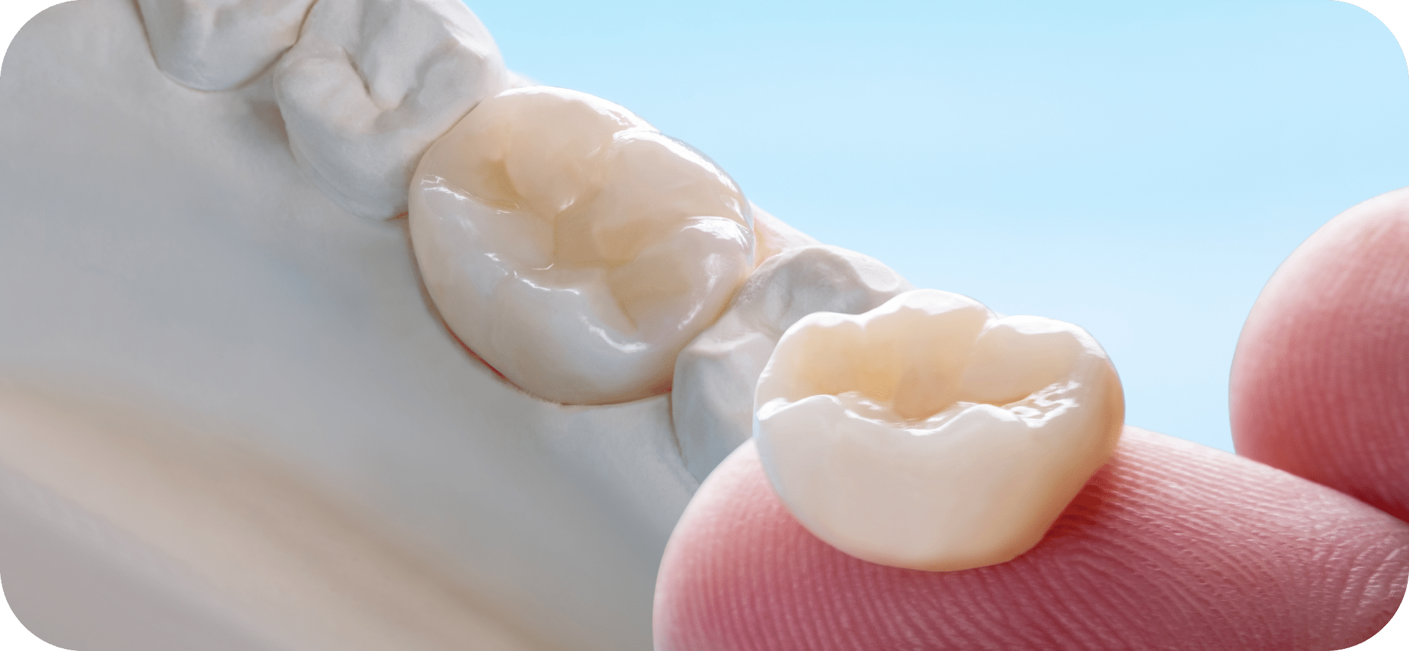 CEREC One-Visit Crown - Precision Dentistry of Howard