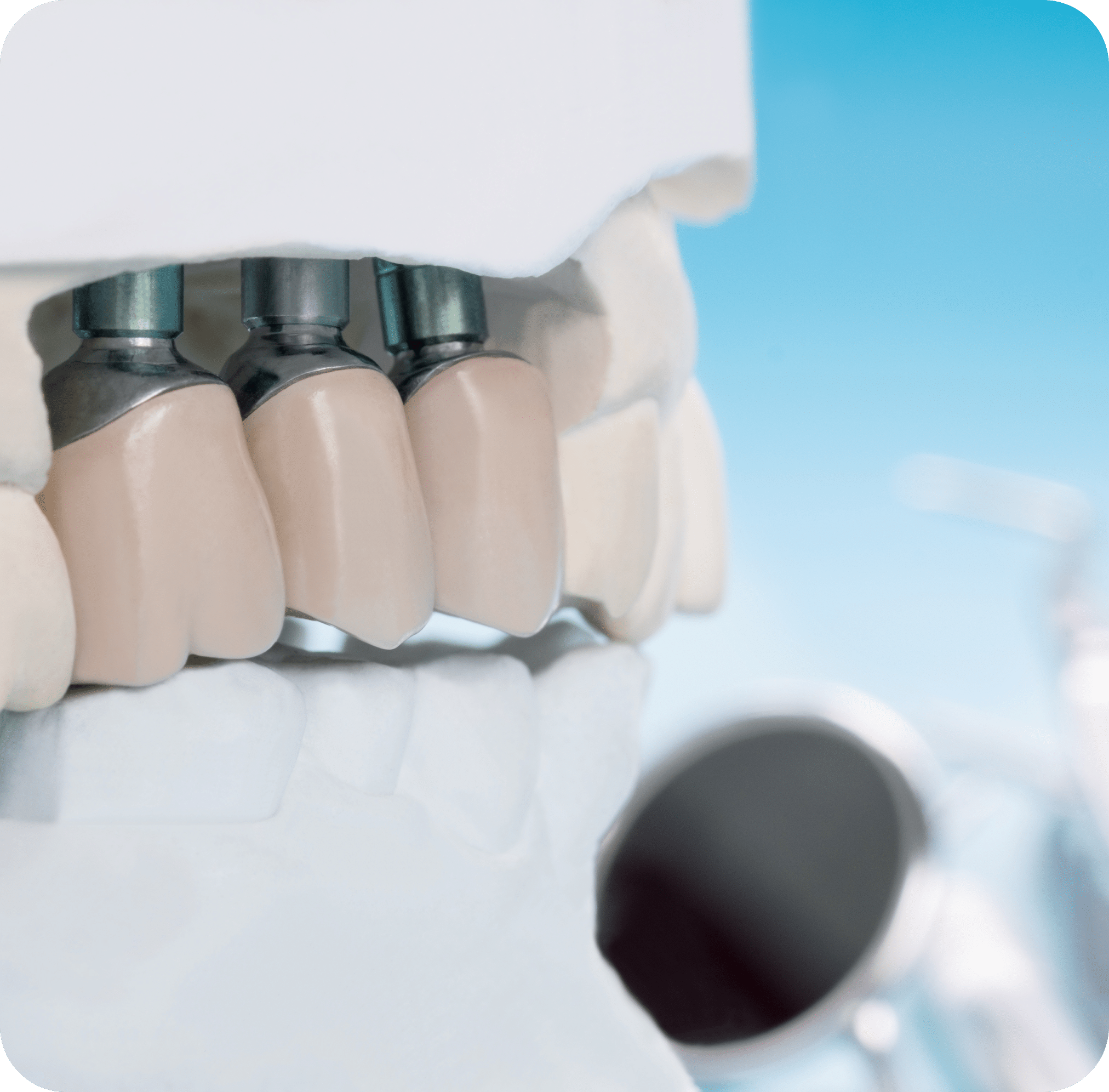 Dental Bridge - Precision Dentistry of Howard