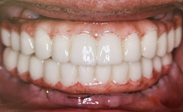 Blog - Precision Dentistry of Howard