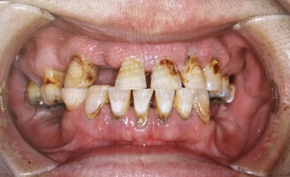 Blog - Precision Dentistry of Howard